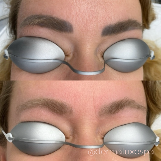 Microblading removal houston