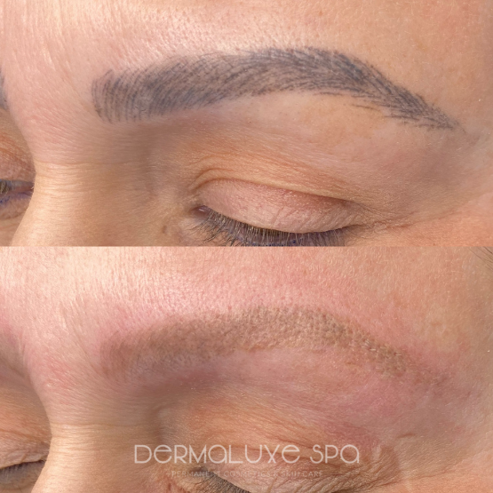 microblading removal in houston tx