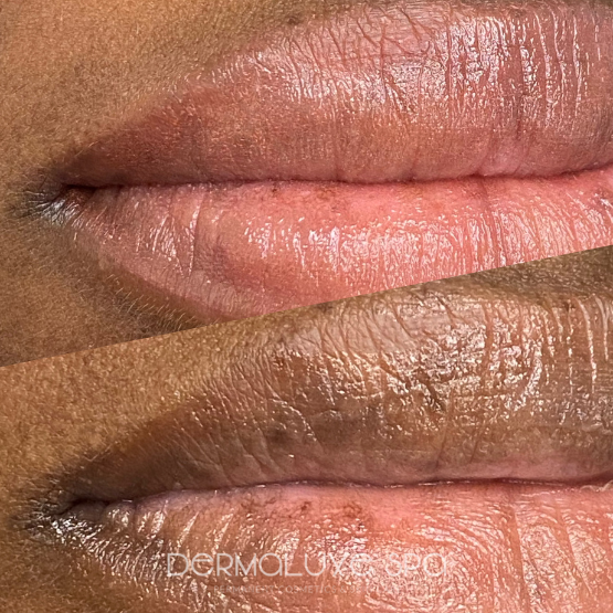 Lip neutralization houston