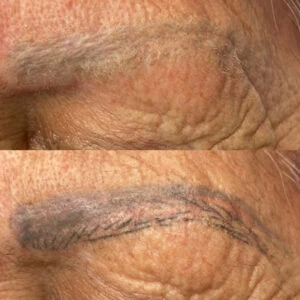 Botched Microblading Removal Houston - Book your consultation today at Dermaluxe Spa!