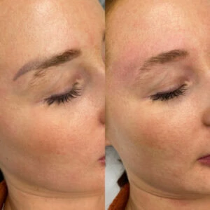 Before and After Laser Eyebrow Removal in Houston - Book today Dermaluxe Spa
