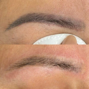 Laser Eyebrow Removal-before and after - Dermaluxe Spa