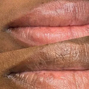 Lip Neutralization Houston - Lighten Dark Lips - Dermaluxe Spa