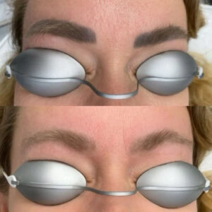 Pico Laser Microblading Removal Houston - Dermaluxe Spa Book Today!