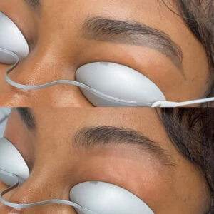 Laser brow tattoo removal for dark skin - Dermaluxe Spa