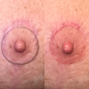 Professional areola tattoo artist performing paramedical tattooing