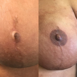 Paramedical areola tattoo procedure restoring natural nipple color