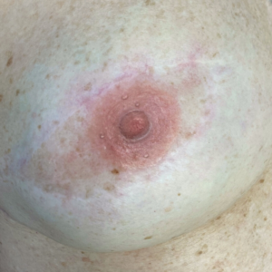 Natural looking 3D areola tattoo result after mastectomy