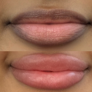 lip neutralization before and after results